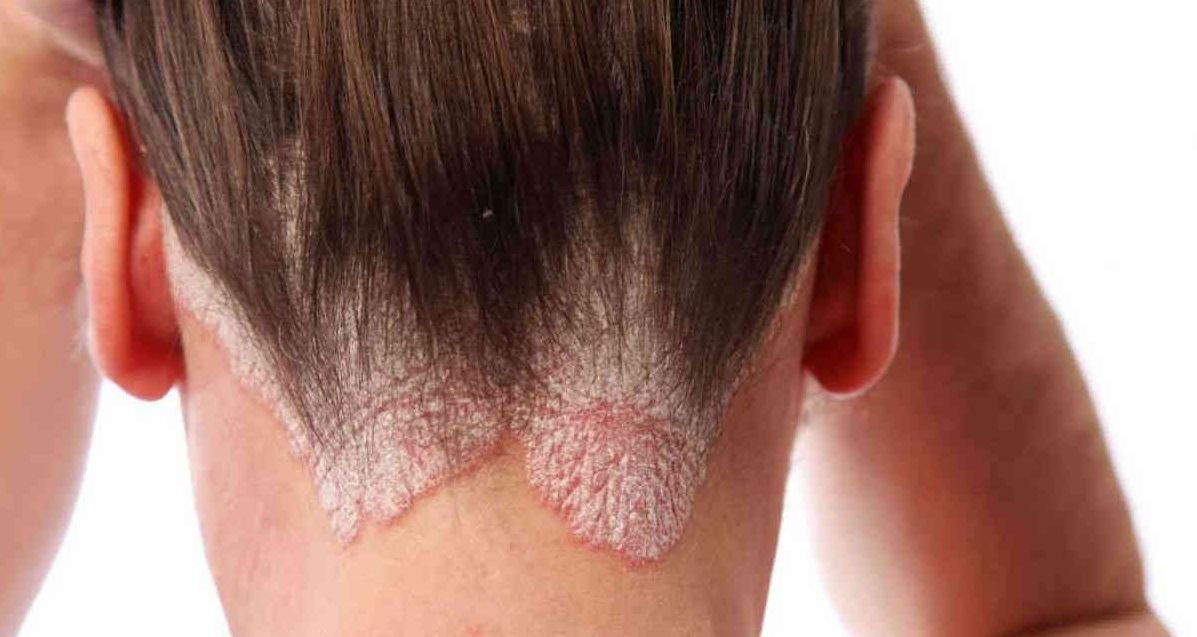 Psoriasis en el pelo
